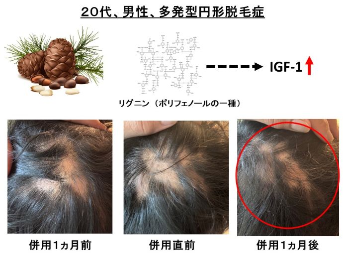 円形脱毛症　病院